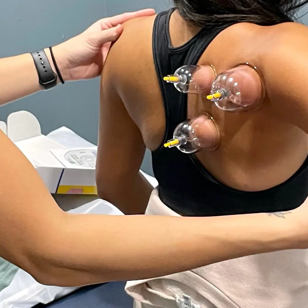 Cupping Therapy